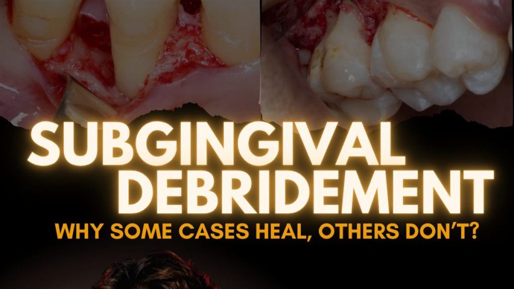 Subgingival Debridement: Beyond Deep Scaling